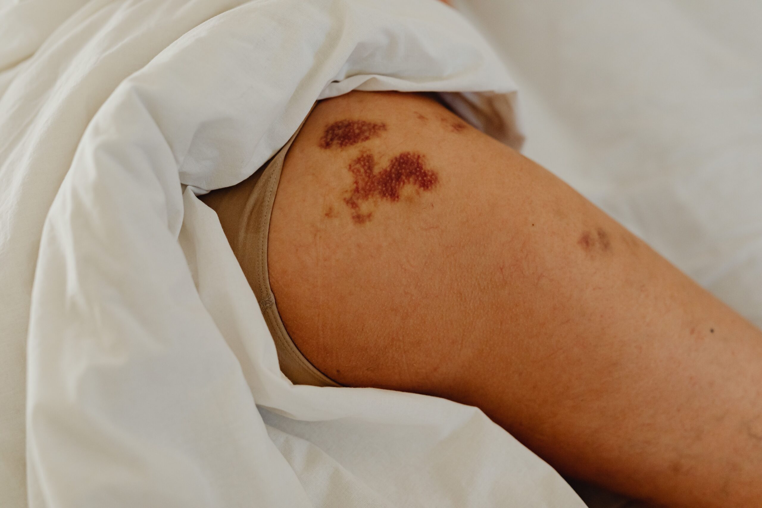 Detailed close-up of human leg with red marks, partially covered by bed sheets.